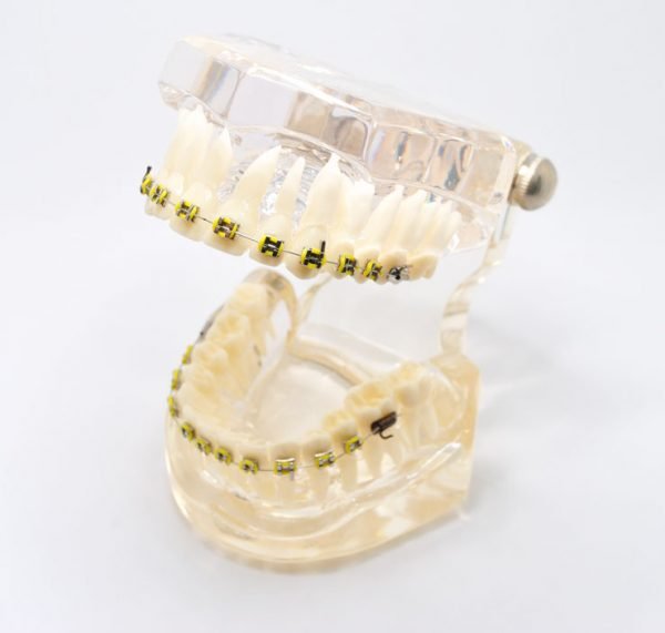 Model typodont orto transparent bracketi metalici tipodont