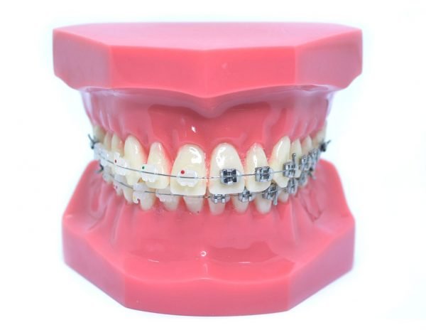 Model typodont orto roz cu bracketi metalici si ceramici