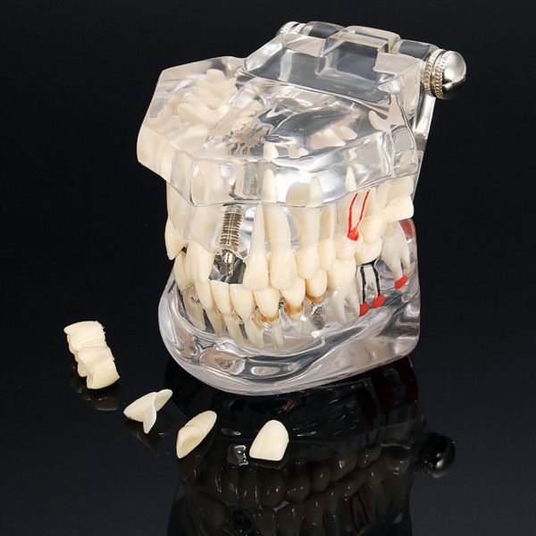 Model typodont patologic model 1 cu restaurari si dinti detasabili tipodont