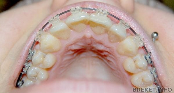 Arcuri ortodontice NiTi rotund