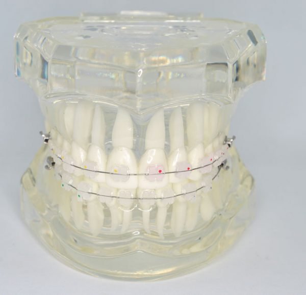 Model typodont orto transparent cu bracketi ceramici