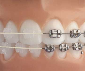 Arcuri ortodontice NiTi rectangular Estetice