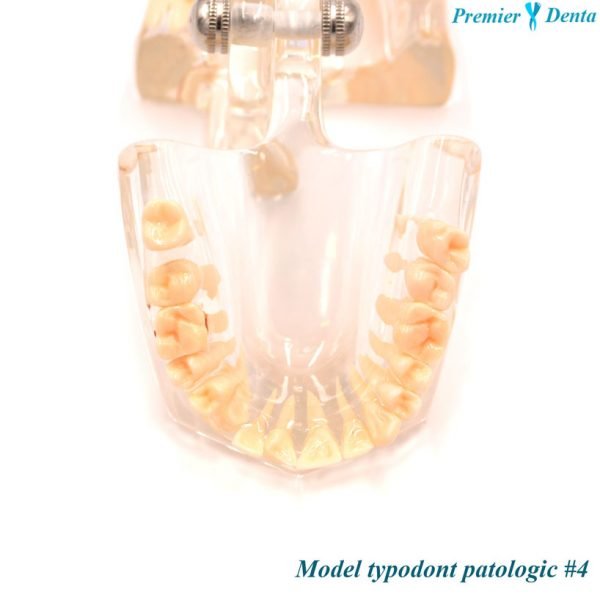 Model typodont patologic model 4