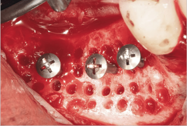 Set suruburi tenting set 9 suport surubelnita chirurgie orala augmentare osoasa DRM.9100SET